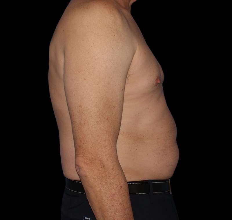 Liposuction Before & After Patient #2756