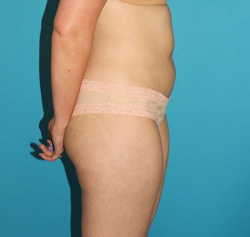Liposuction Before & After Patient #2767