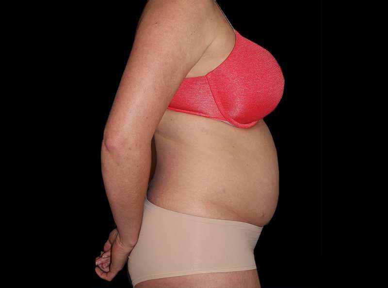 Liposuction Before & After Patient #2778
