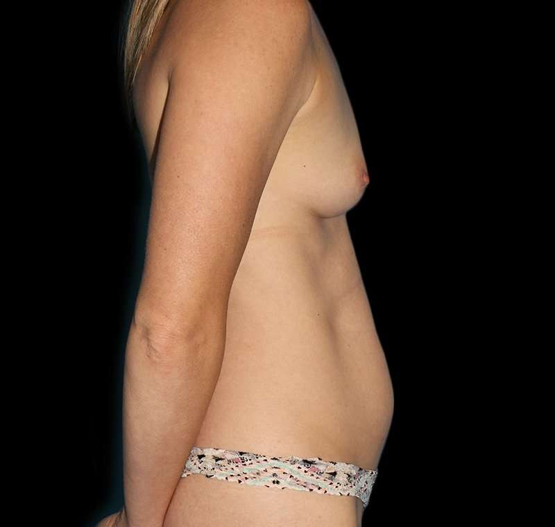 Liposuction Before & After Patient #2800