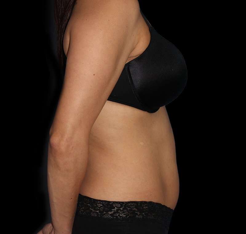 Liposuction Before & After Patient #2811