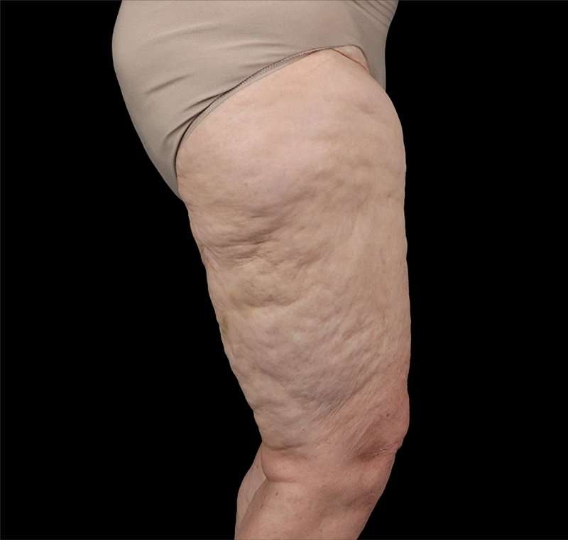 Liposuction Before & After Patient #2829
