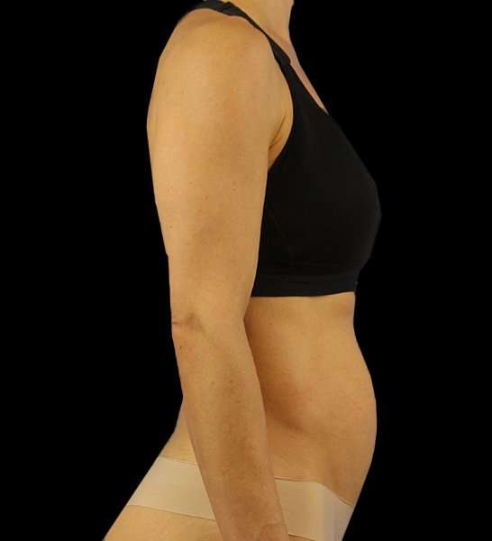Mini Tummy Tuck Before & After Patient #2856