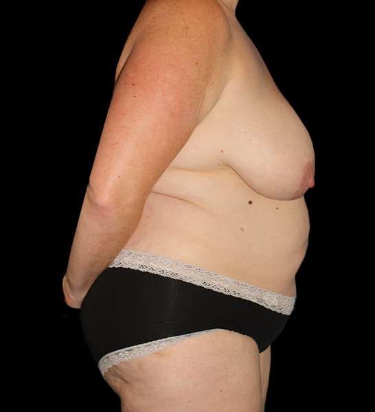 Mommy Makeover Before & After Patient #2867