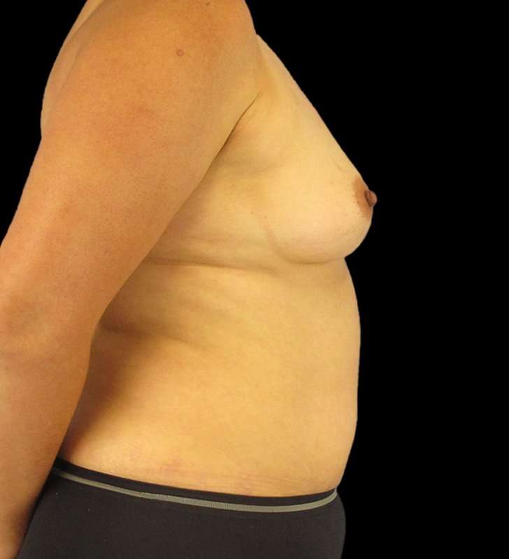 Mommy Makeover Before & After Patient #2878