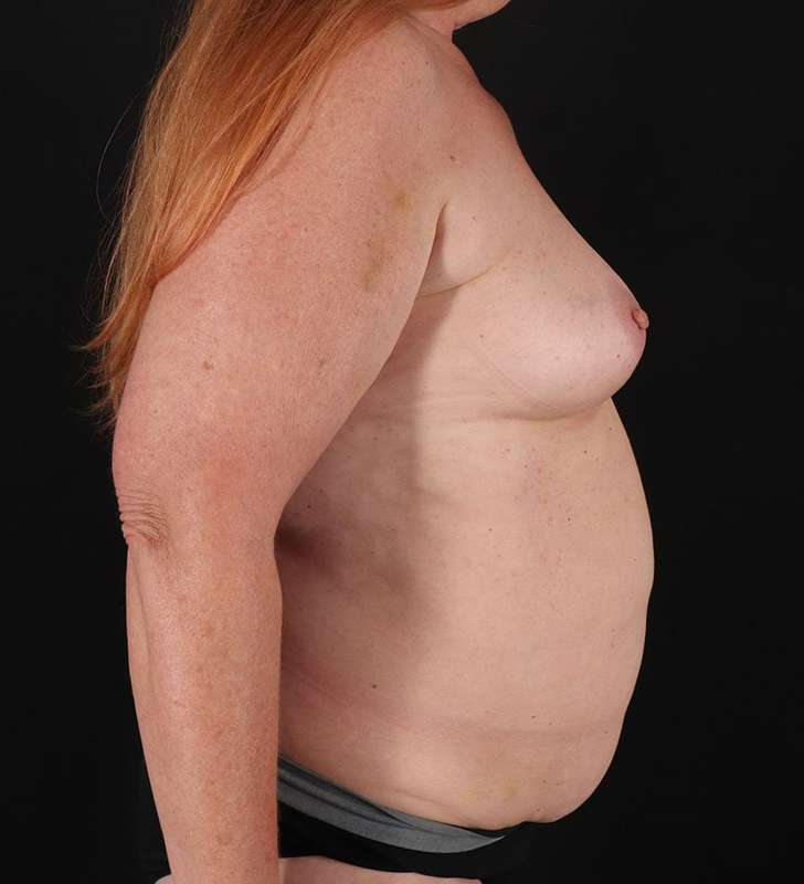 Mommy Makeover Before & After Patient #2913