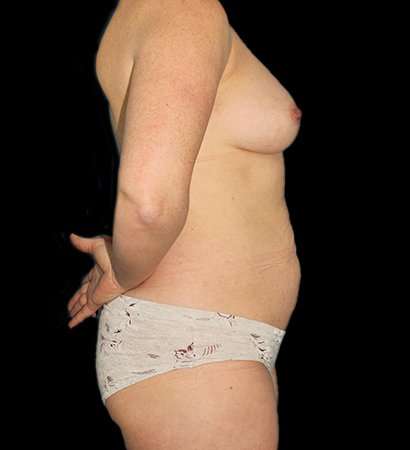 Mommy Makeover Before & After Patient #2974