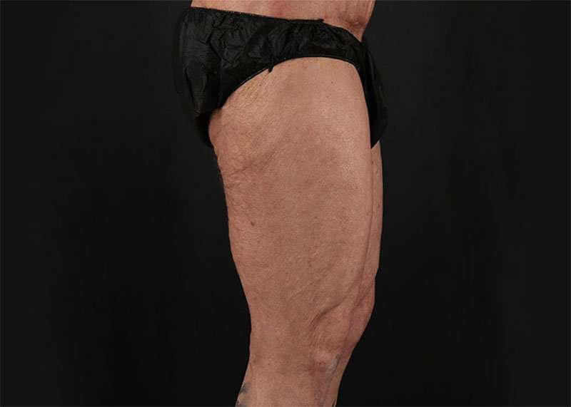 Thigh Lift Before & After Patient #2992