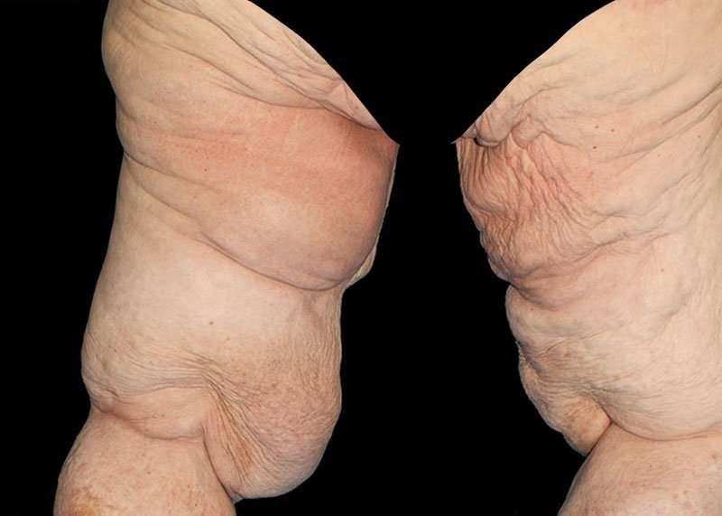 Thigh Lift Before & After Patient #3005