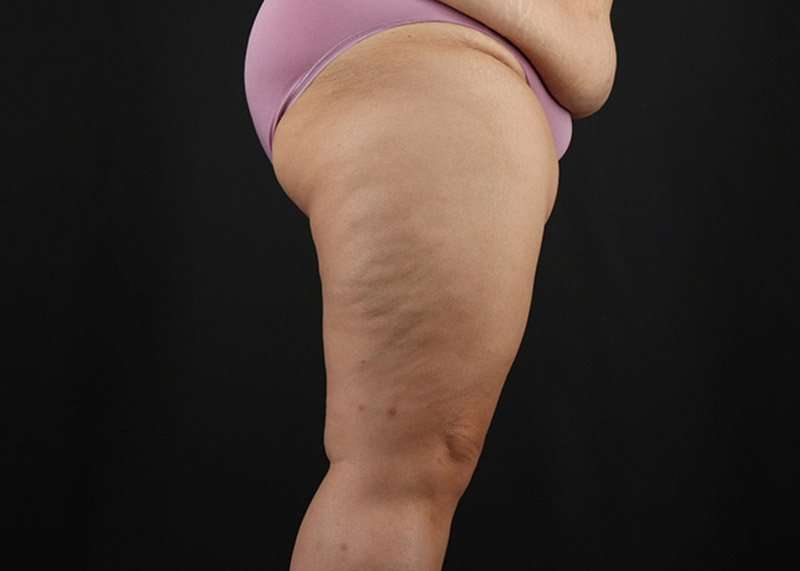 Thigh Lift Before & After Patient #3018