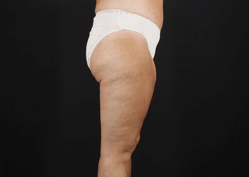 Thigh Lift Before & After Patient #3031
