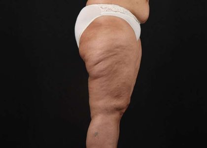 Thigh Lift Before & After Patient #3044