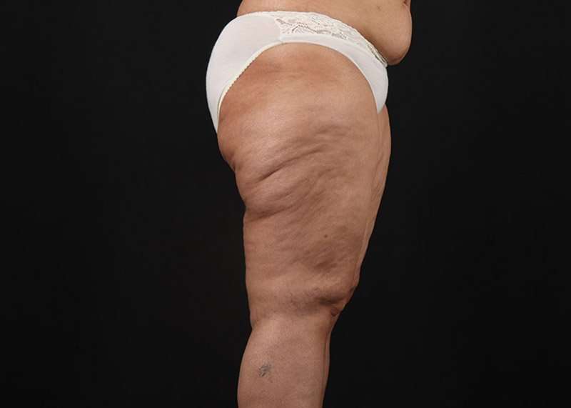 Thigh Lift Before & After Patient #3044