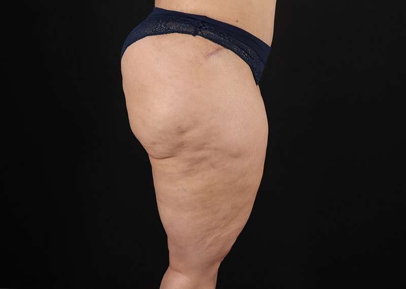 Thigh Lift Before & After Patient #3057