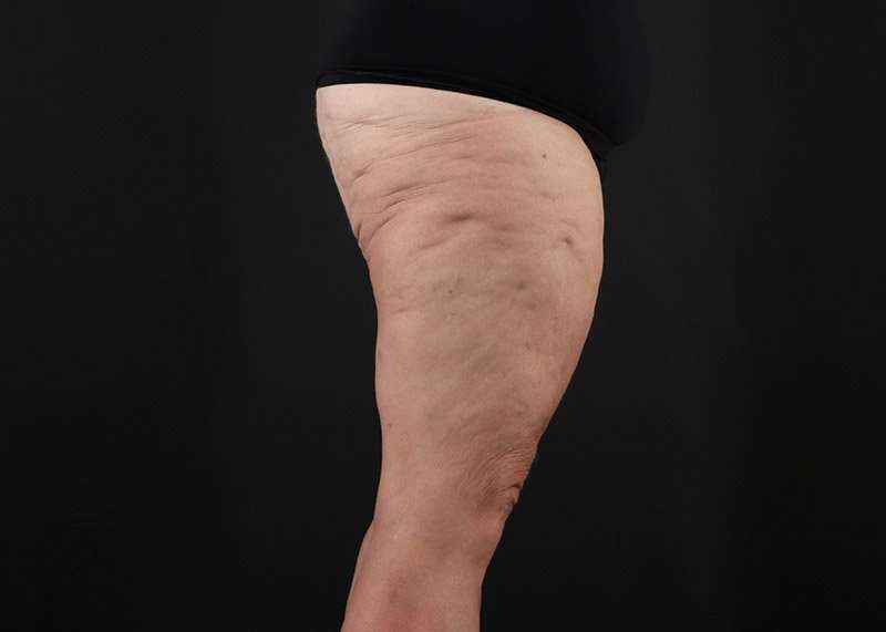 Thigh Lift Before & After Patient #3070