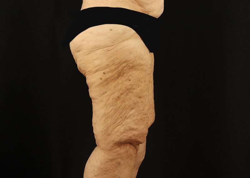 Thigh Lift Before & After Patient #3083