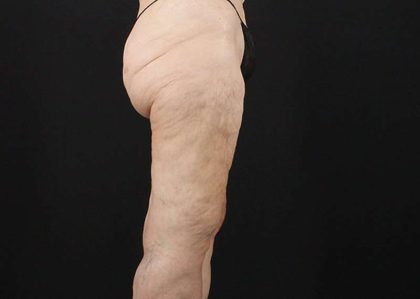 Thigh Lift Before & After Patient #3096
