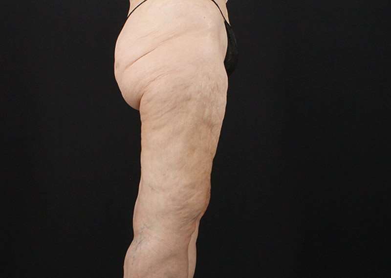 Thigh Lift Before & After Patient #3096