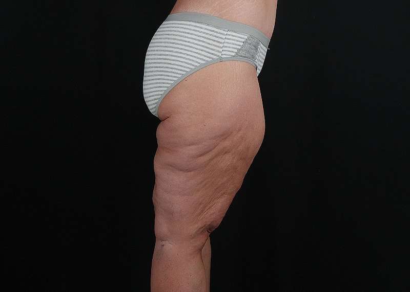 Thigh Lift Before & After Patient #3109