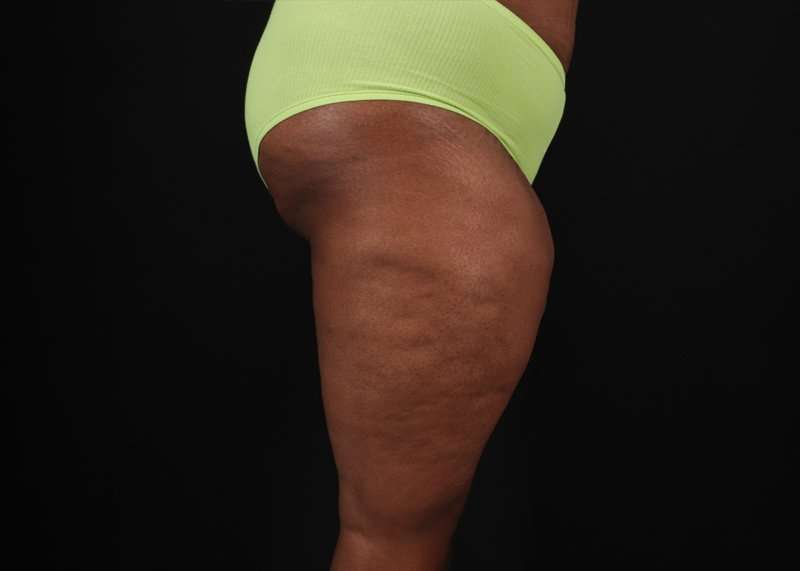 Thigh Lift Before & After Patient #3122