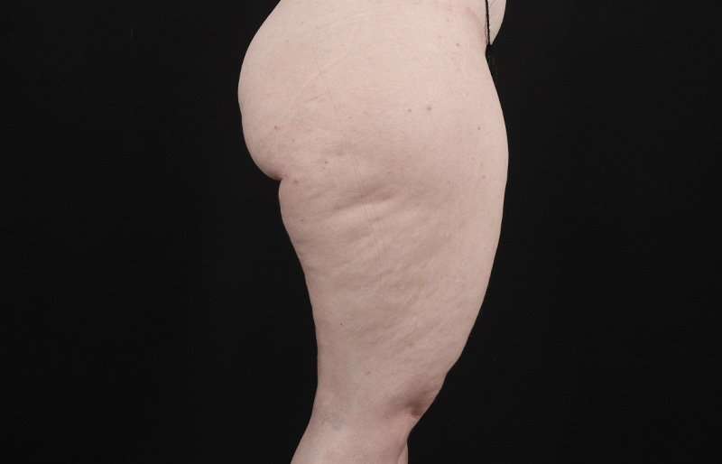 Thigh Lift Before & After Patient #3135