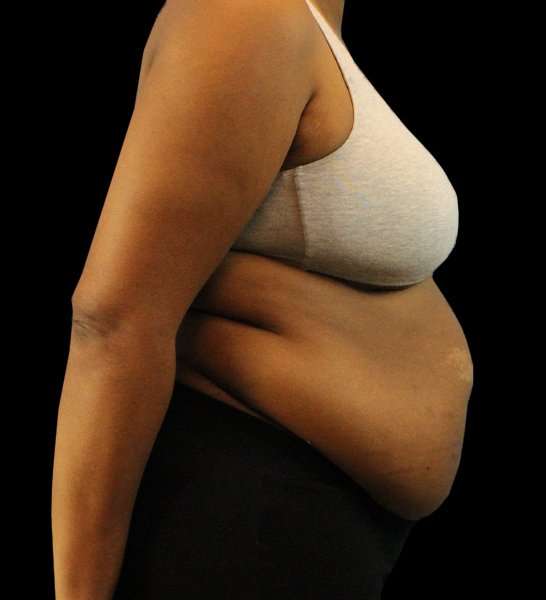 Tummy Tuck Revision Before & After Patient #3146