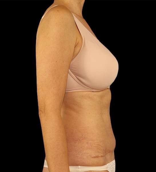 Tummy Tuck Revision Before & After Patient #3157