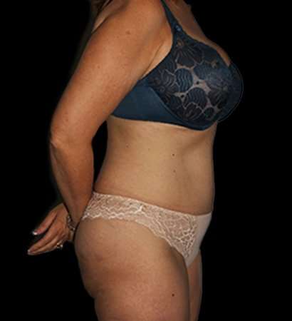 Tummy Tuck Revision Before & After Patient #3168