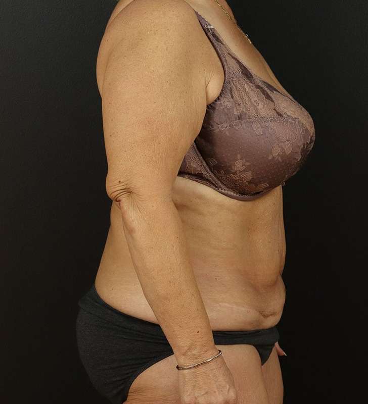 Tummy Tuck Revision Before & After Patient #3181