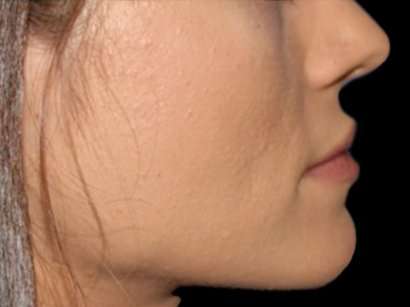 Lip Augmentation - Fat Grafting Before & After Patient #3210