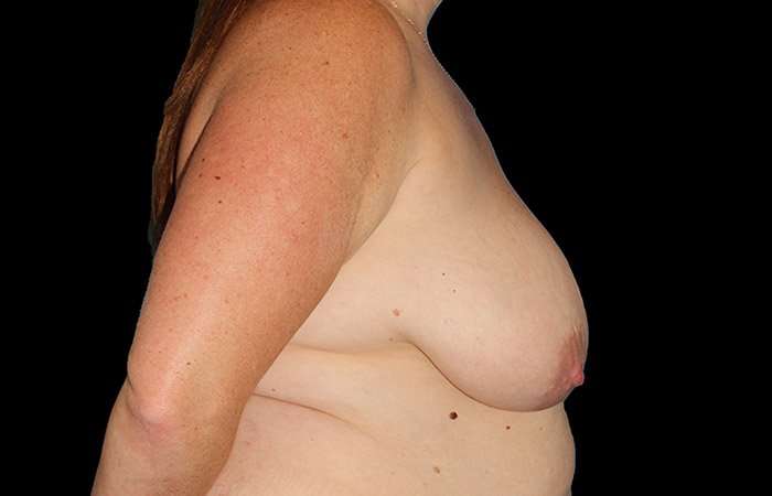Breast Lift Before & After Patient #1094