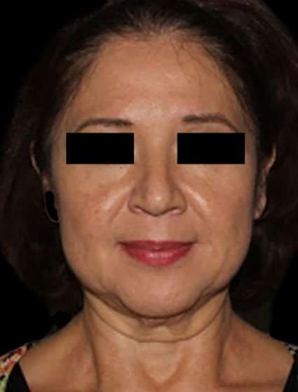 Face & Neck Lift Before & After Patient #3248