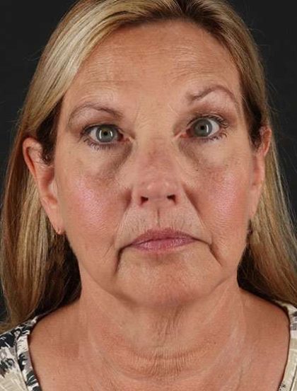 Face & Neck Lift Before & After Patient #3259