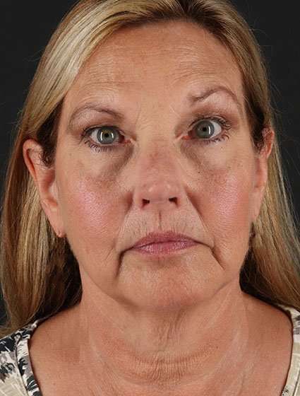Face & Neck Lift Before & After Patient #3259