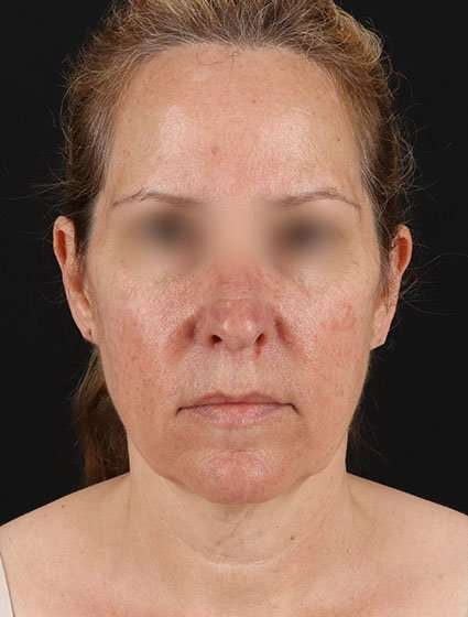 Face & Neck Lift Before & After Patient #3270