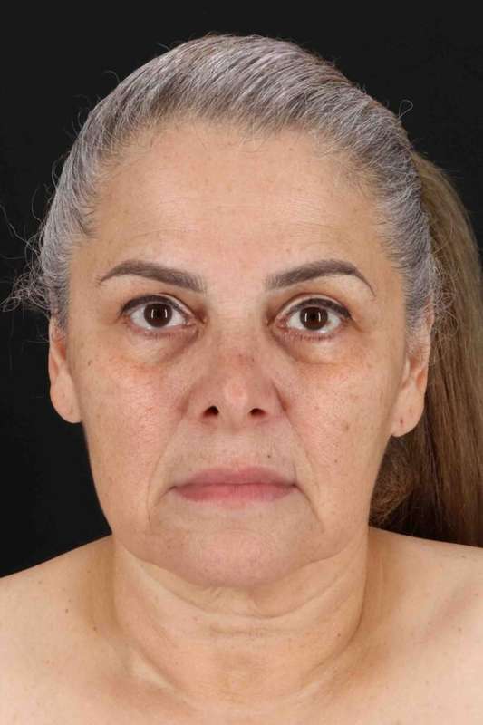 Face & Neck Lift Before & After Patient #3292