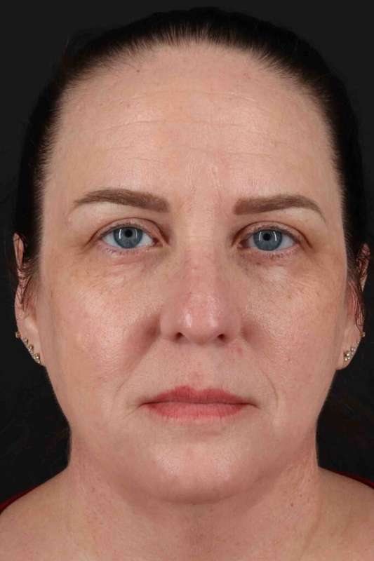 Face & Neck Lift Before & After Patient #3303