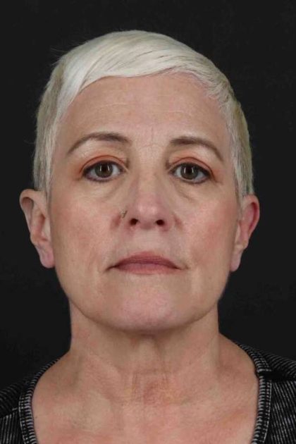 Face & Neck Lift Before & After Patient #3314
