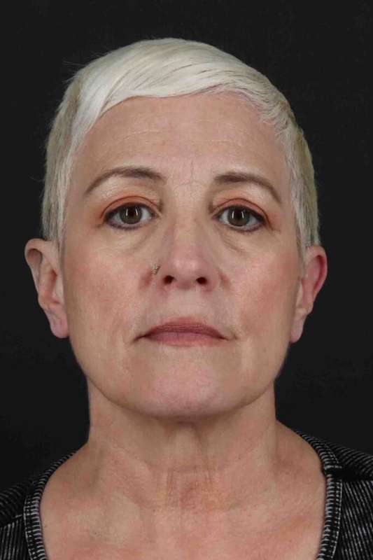 Face & Neck Lift Before & After Patient #3314