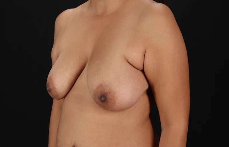 Breast Lift Before & After Patient #1149