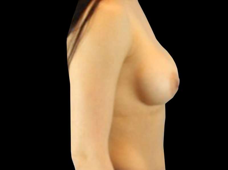 Revision Breast Surgery Before & After Patient #1184