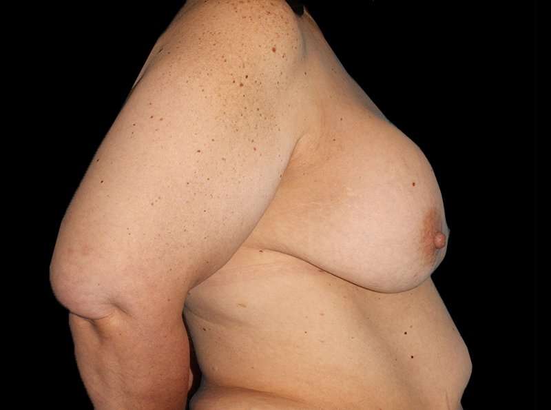 Revision Breast Surgery Before & After Patient #1195