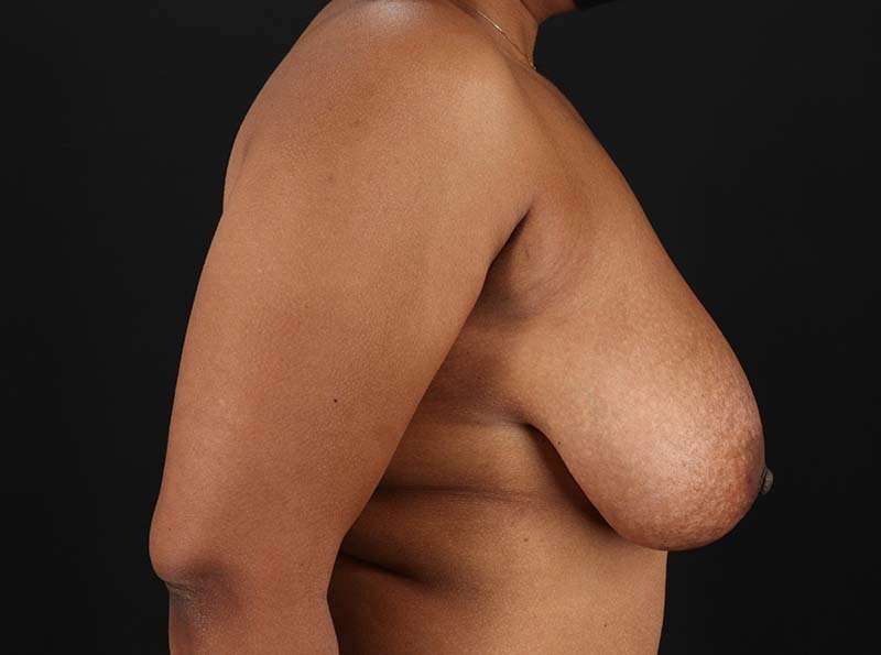 Breast Reduction Before & After Patient #1217