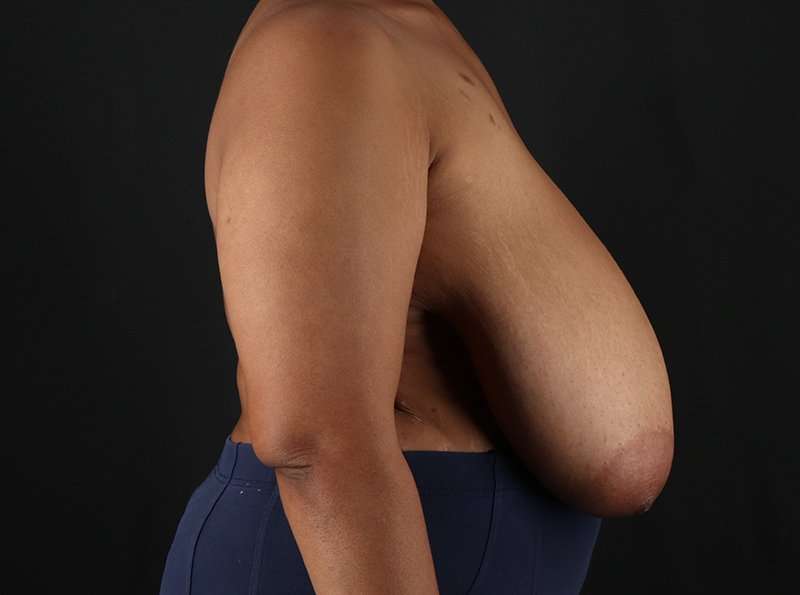 Breast Reduction Before & After Patient #1228