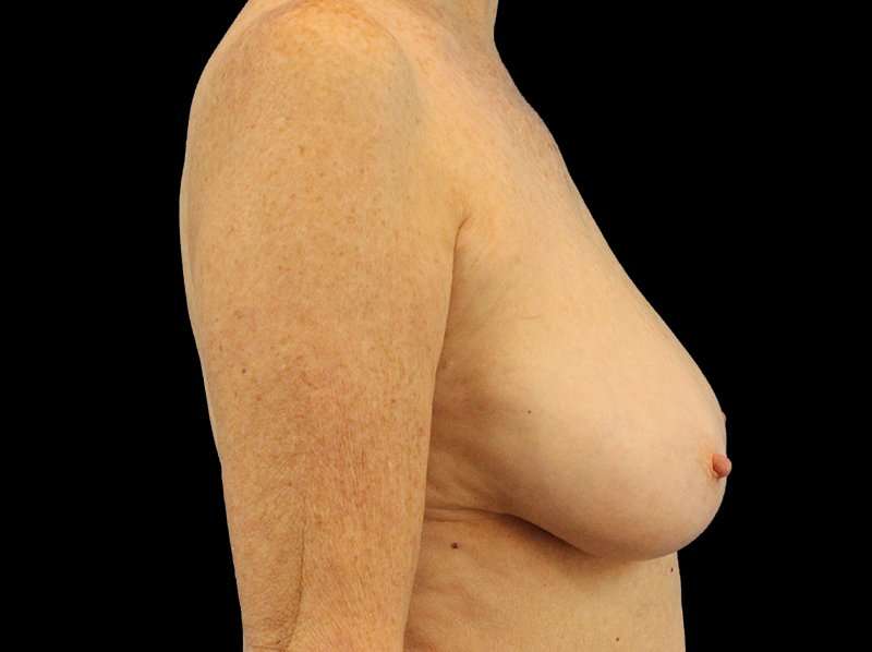 Breast Reduction Before & After Patient #1239
