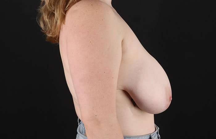 Breast Reduction Before & After Patient #1250