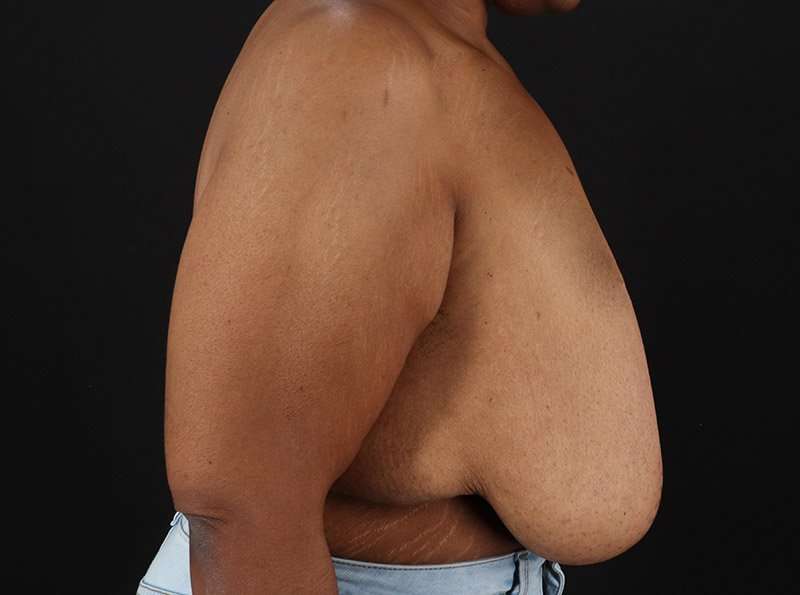 Breast Reduction Before & After Patient #1272