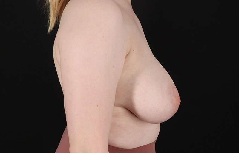 Breast Reduction Before & After Patient #1305