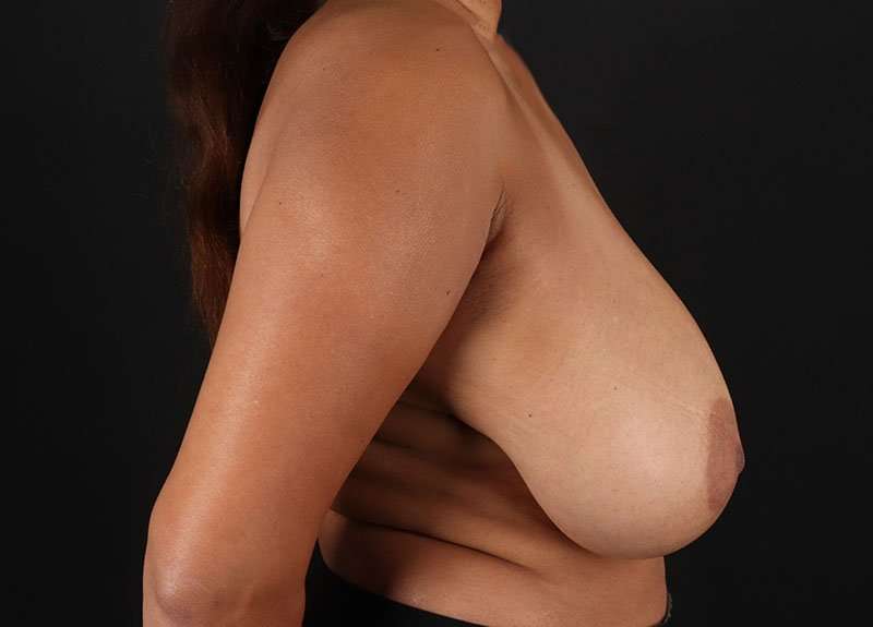 Breast Reduction Before & After Patient #1332