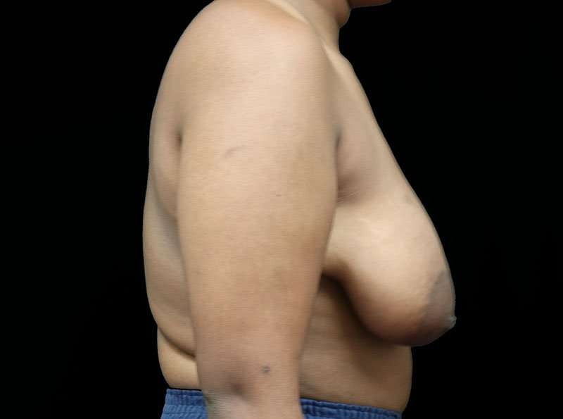 Breast Lift Before & After Patient #1343